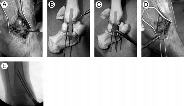 left ankle figure 1 Photo