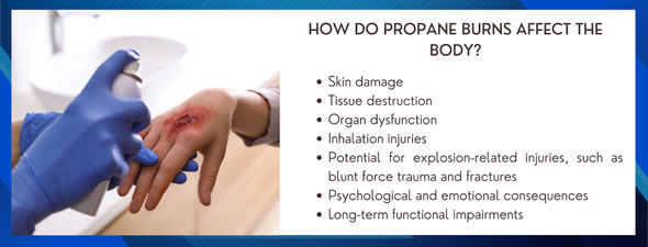 propane burns affect photo